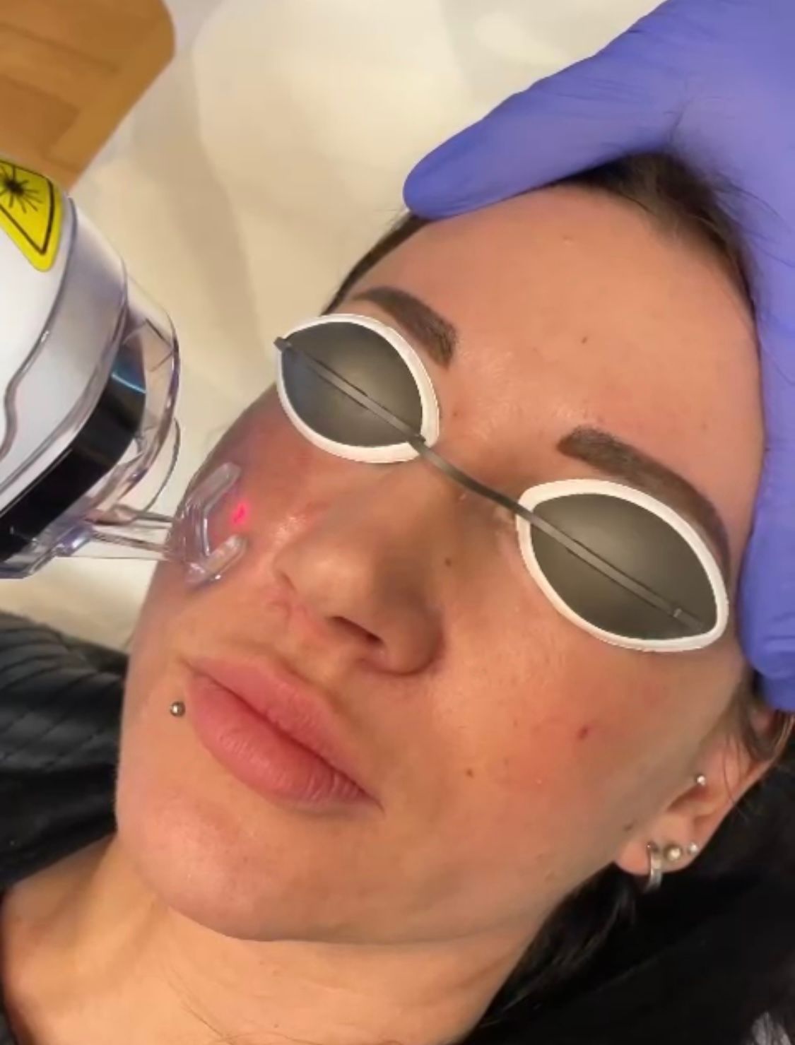 Fractional CO₂ laser treatment with eye protection