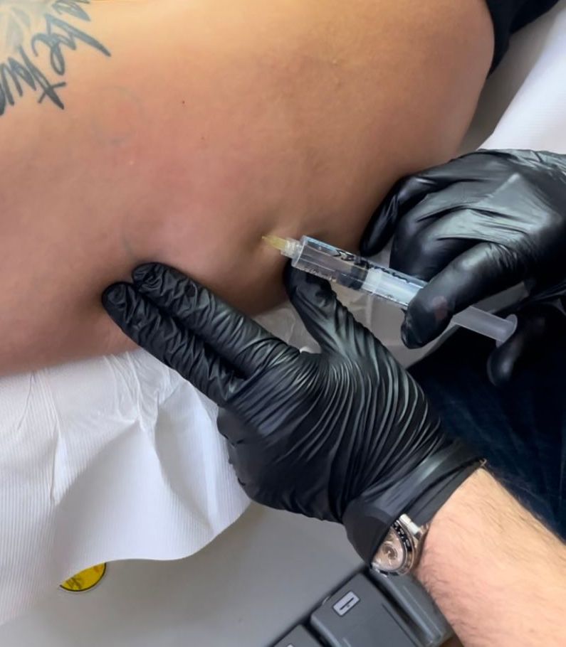Injection Lipolysis