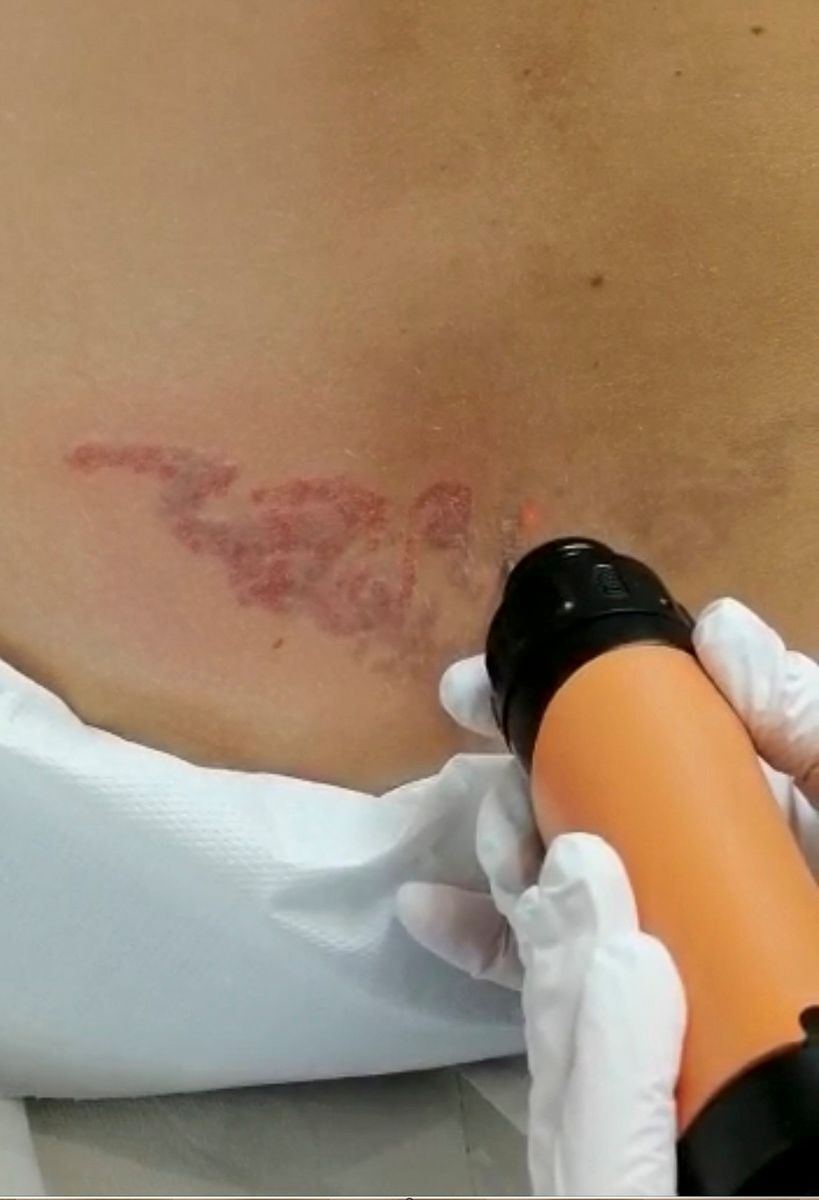 Laser-Tattooentfernung